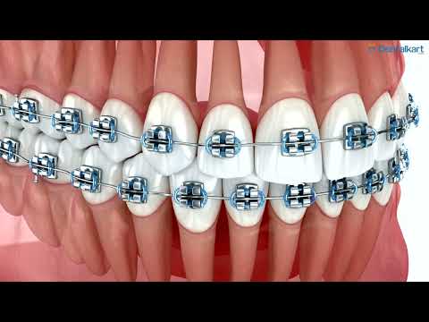 U Ortho NiTi Archwire - Rectangular (pack of 10) - 2