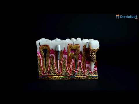 iDENTical Diseased Teeth and Gums Model M4029 - 2