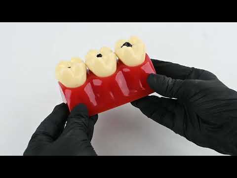 iDENTical Caries Development Tooth Model M4020 - 2