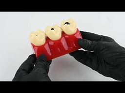 iDENTical Caries Development Tooth Model M4020 - 2