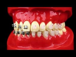 iDENTical Half Metal and Half Ceramic Brackets Orthodontic Models M3003 - 2