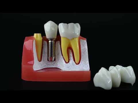 iDENTical Implant Analysis Model - M2017 - 2