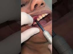 Julldent 169 Pterygoid Path Finder ILM Tool - 2