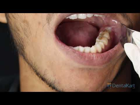 Julldent Minneasota Retractor