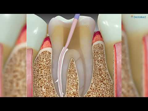 Waldent Seal-Pex - 3