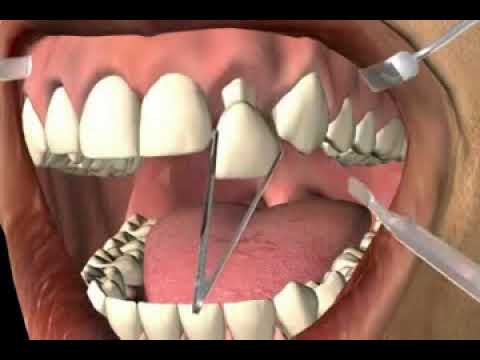 GDC Temporary Crown Removing Plier CR4562 - 2