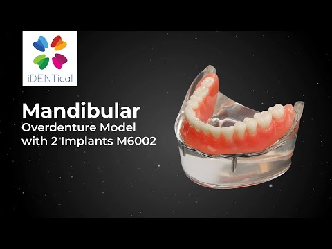 iDENTical Mandibular Overdenture Model with 2 Implants M6002 - 2