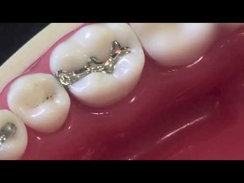 Dpi Fine Grain Dental Silver Alloy - 2