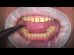 Bausch Dental Articulating Paper with Progressive Colour Transfer - 100µ Microns - 2