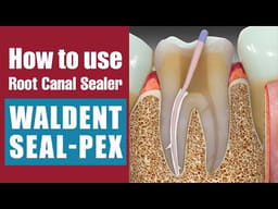 Waldent Seal-Pex - 2