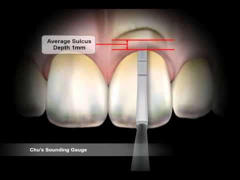 Hu-Friedy Sounding Gauge (SOUNDG) - 2