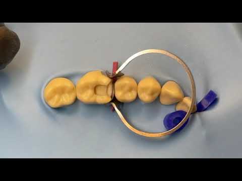 Tor Vm Add-On Fixing Wedges (40pcs) No. 1.861 - 2