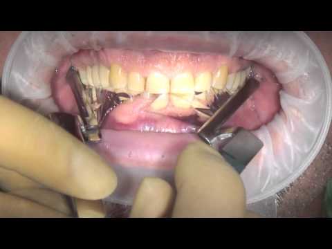 Bausch Dental Arti Fol Metallic Shimstock Flim 12µ Microns - 2