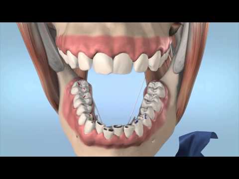 Bausch Arti-Fol Dental Articulating Flim Ultra Thin - 8µ Microns Width 22 mm - 22 Mts. - 2