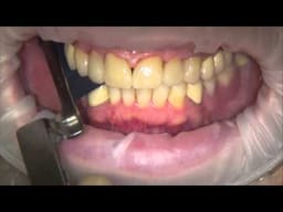 Bausch Dental Articulating Papers with Progressive Colour Transfer - 200µ Microns - 2