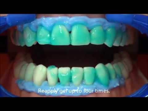 SDI Pola Office Bleaching Kit - 2