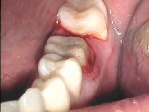 Ultradent Viscostat - Kit & Refills - 2