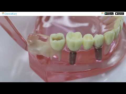 Waldent Paste Carrier (Lentulo Spiral) 21mm (Pack of 4) - 2