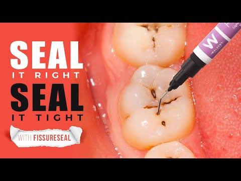 Waldent FissureSeal Pit & Fissure Sealant LC - 2