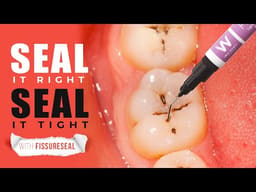 Waldent FissureSeal Pit & Fissure Sealant LC - 2