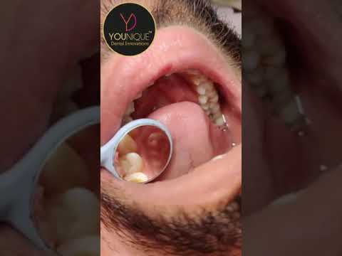 Younique M2 Rainbow Dental Mirror With Endo Gauge - 2