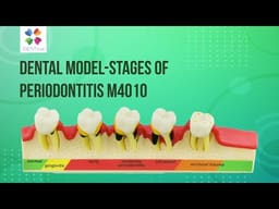 iDENTical Stages Of Periodontitis Model - M4010 - 2