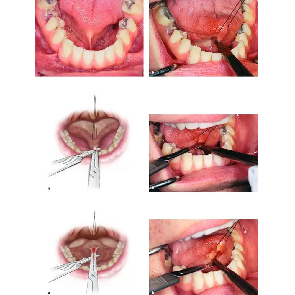 Waldent Hemostats ( Artery Forcep) 
