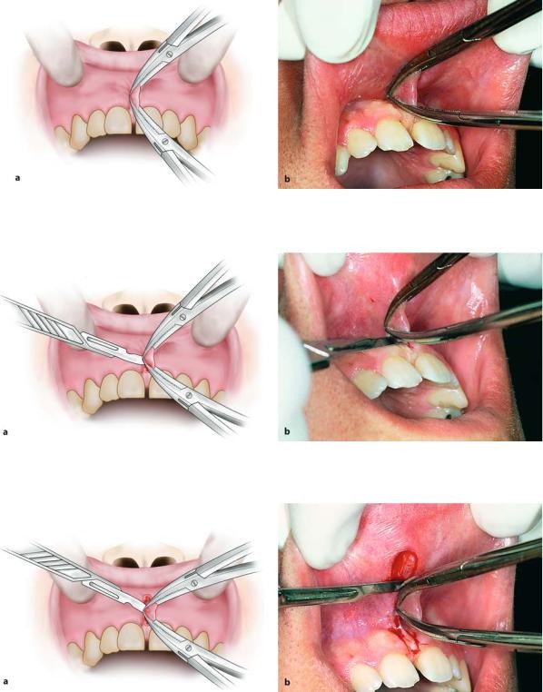 GDC Hemostats Mosquito Curved 1x2 - (12.5cm) (H6)
