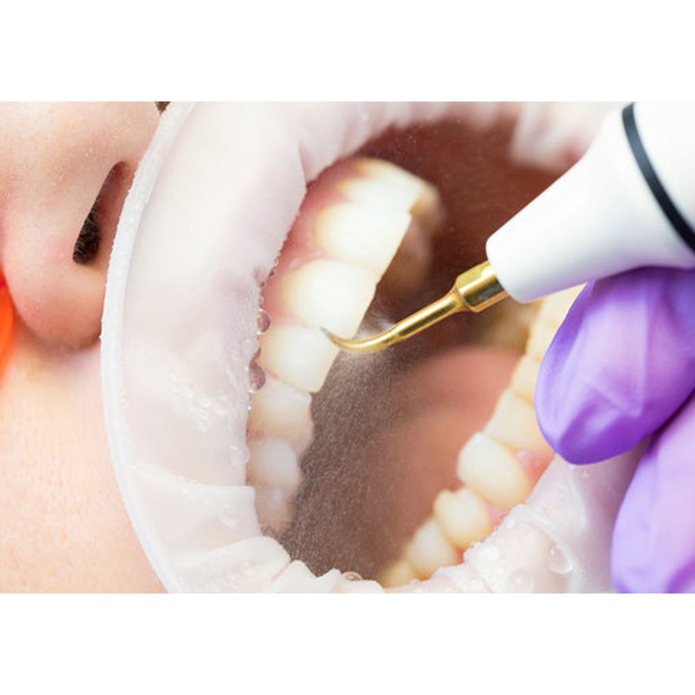 Woodpecker Ultrasonic Scaler Handpiece - HD 