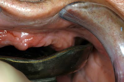 Waldent Edentulous Non-Perforated Impression Trays K18/2