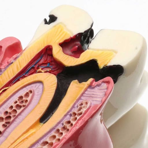 iDENTical Caries V/S Healthy Teeth Model M4021