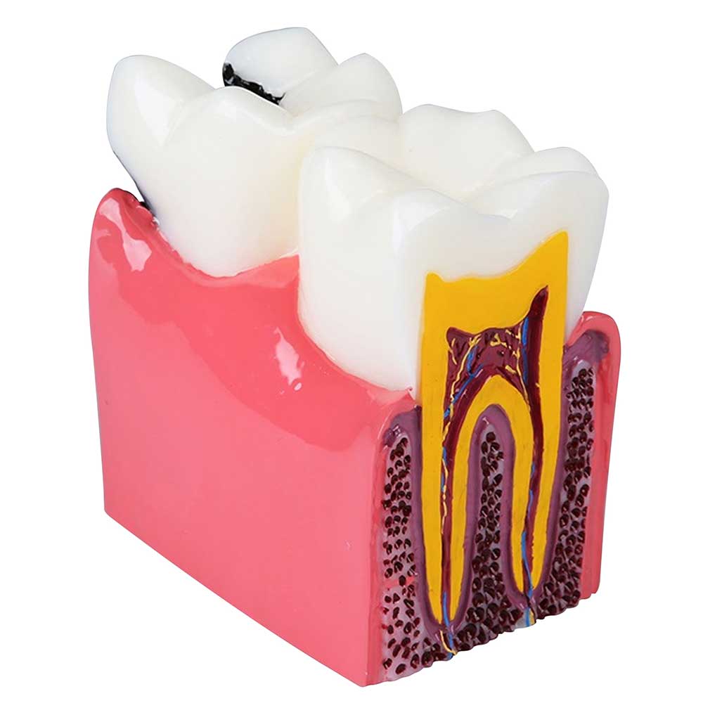 iDENTical Caries V/S Healthy Teeth Model M4021