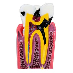 iDENTical Caries V/S Healthy Teeth Model M4021 - 4