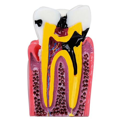 iDENTical Caries V/S Healthy Teeth Model M4021