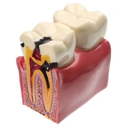 iDENTical Caries V/S Healthy Teeth Model M4021 - 3
