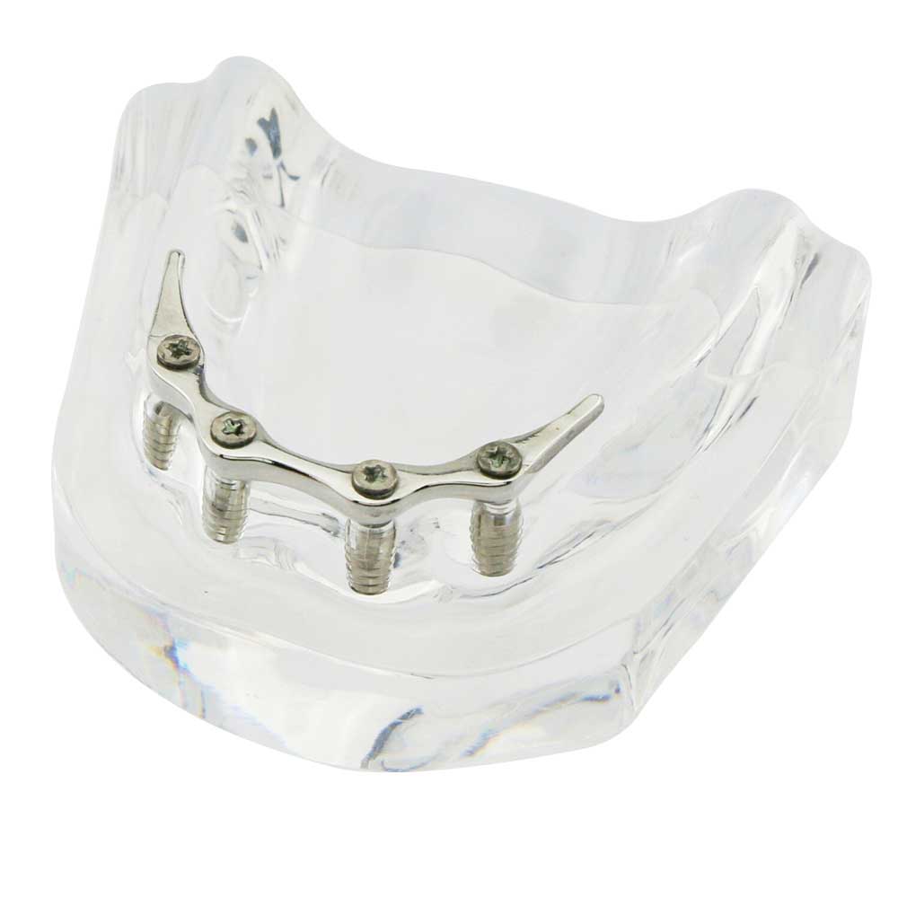 iDENTical Implant Model With Silver Bar M6008