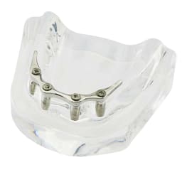 iDENTical Implant Model With Silver Bar M6008 - 9