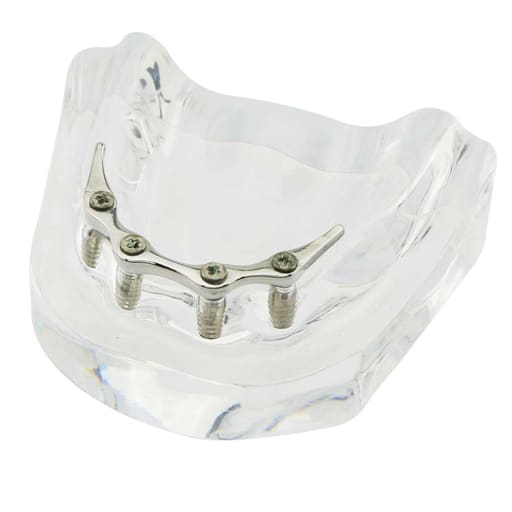 iDENTical Implant Model With Silver Bar M6008