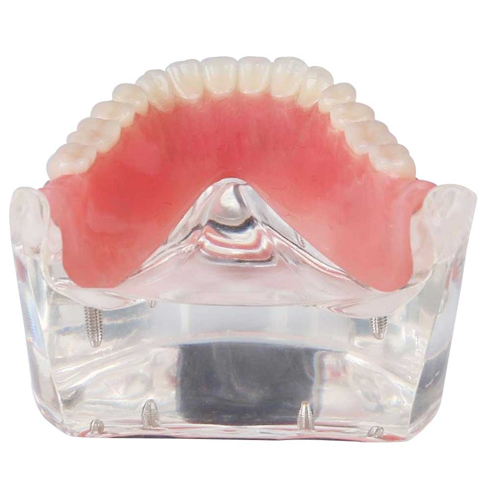 iDENTical Mandibular Overdenture Model with 4 Implants M6003