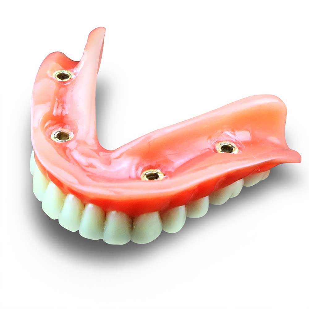 iDENTical Mandibular Overdenture Model with 4 Implants M6003