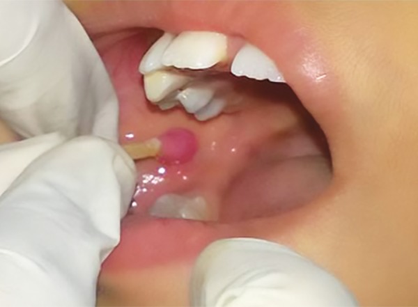 Vishal DentoCare Gel Topical Anaesthetic