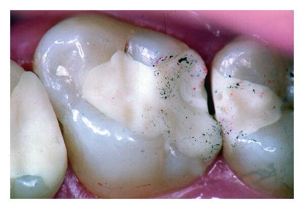 Ammdent Gi Fill Premium GIC 