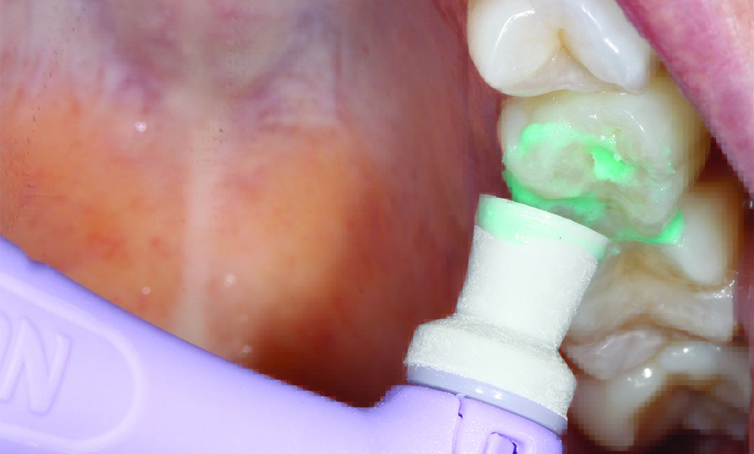 Dentsply Prisma Gloss Polishing Paste