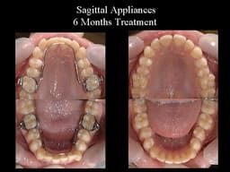 Ortho Organizers Transforce Sagittal Appliance - 7