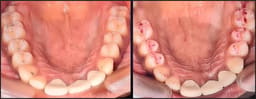 Bausch Dental Articulating Paper with Progressive Colour Transfer - 100µ Microns - 8