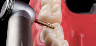 Apple Airotor Handpiece - Standard Head-Push Button (SU)