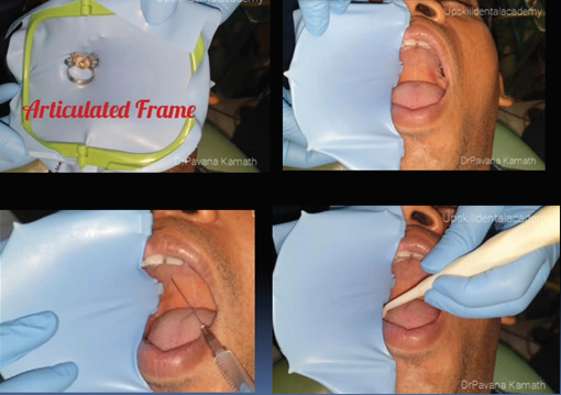 ET Dental Rubber Dam Frames