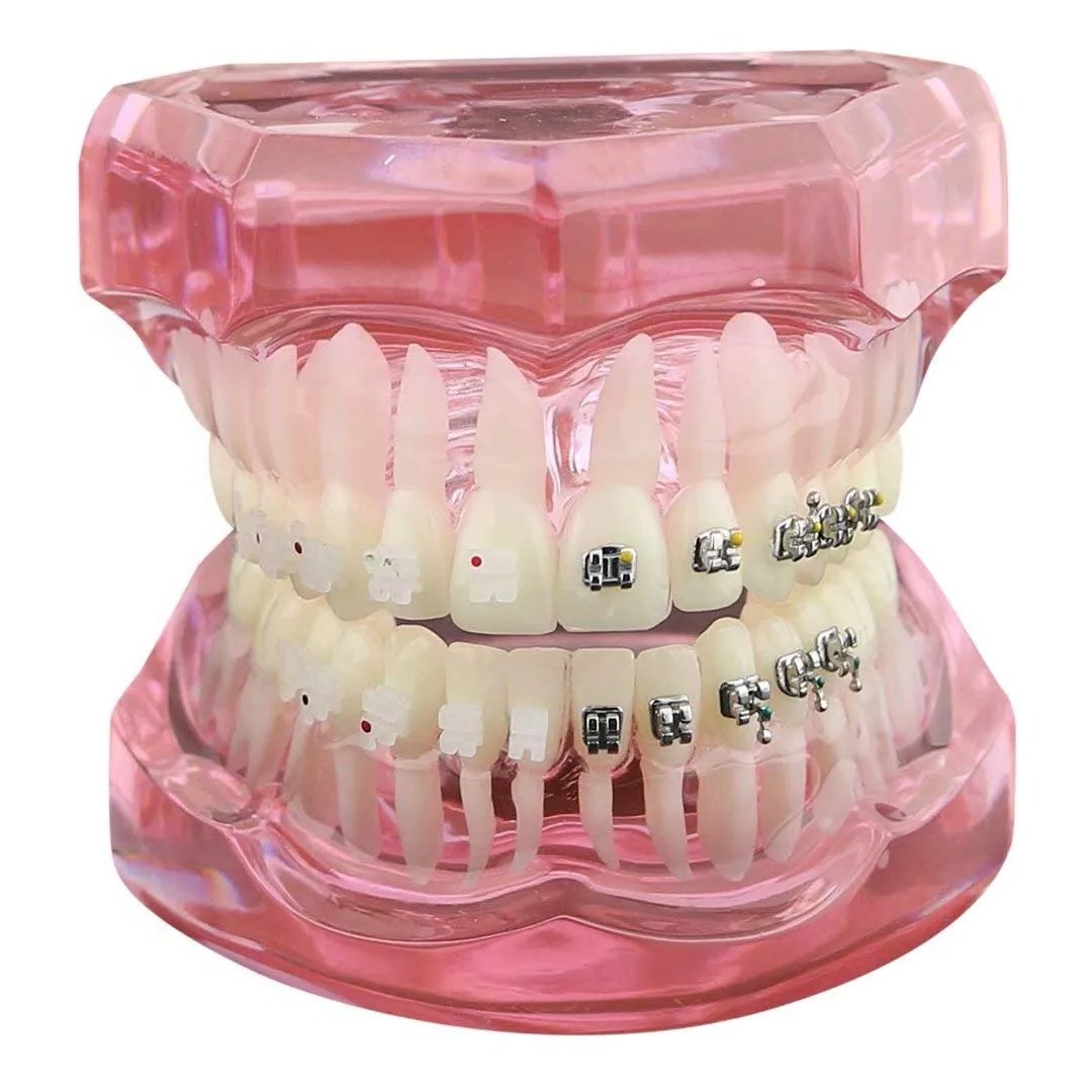 iDENTical Half Metal And Half Ceramic Brackets Orthodontics Model - M3003 (Pink)