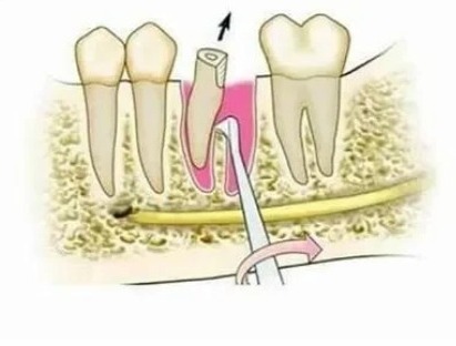 GDC Root Elevators Seldin Standard (E1r)