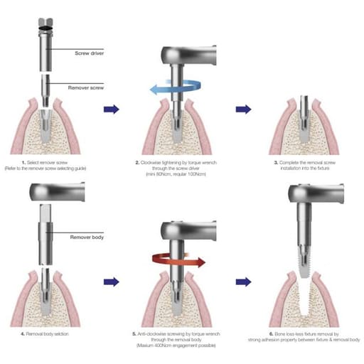 MCTBIO Fixture Remover Kit (FRK-01)